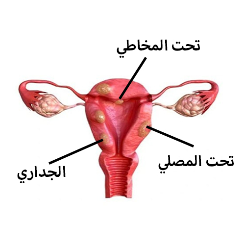 الورم الليفي في الرحم